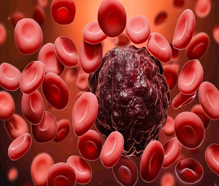 Blood Cancer